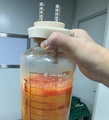 肥城水动力吸脂手术要做多久？
